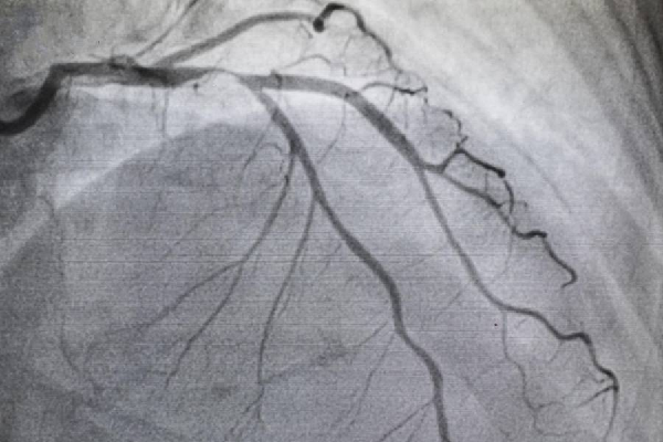 Angiography