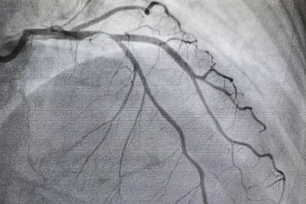 Angiography