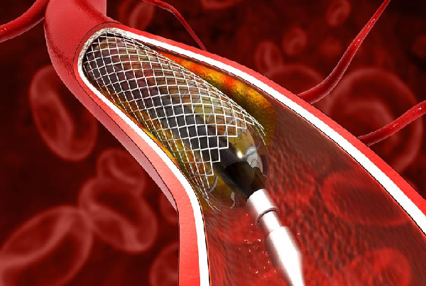 Angioplasty