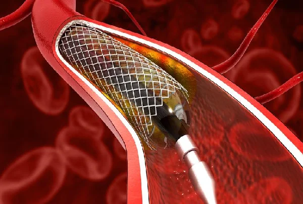 Angioplasty