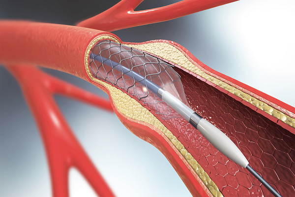 Renal and Peripheral Stenting