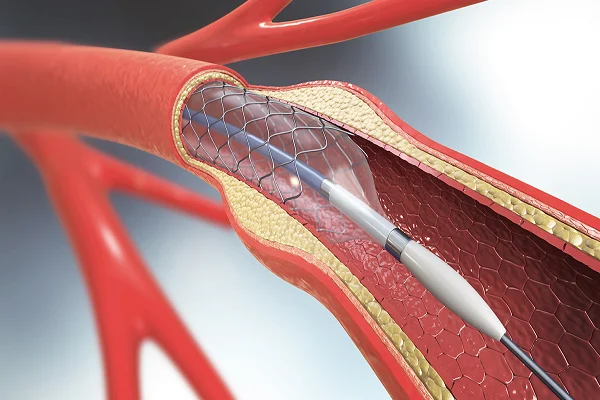 Renal and Peripheral Stenting