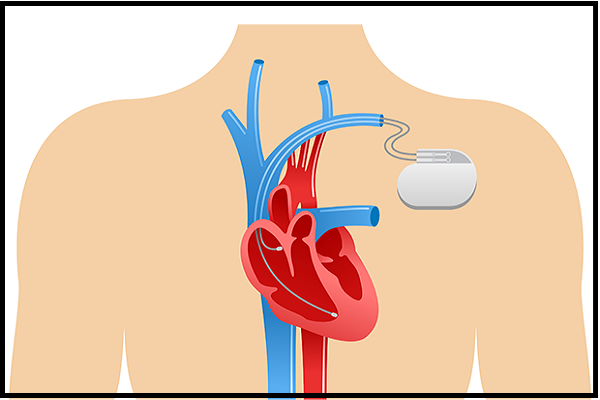 Pacemaker