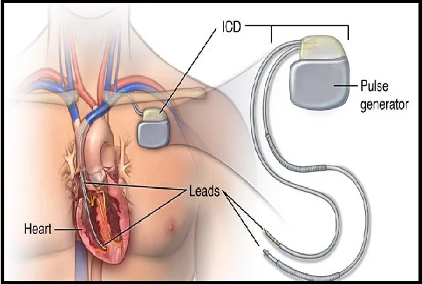 ICD and CRT D Implantation