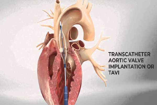 Transcatheter Aortic Valve Implantation