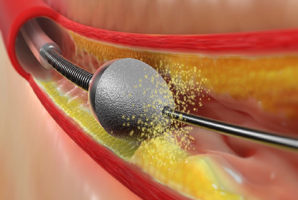 Rotational Atherectomy